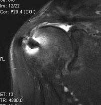 Shoulder MRI Failed Rotator Cuff Repair